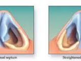 Rhinoplasty, Septoplasty & Septorhinoplasty Surgery