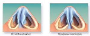 Rhinoplasty, Septoplasty & Septorhinoplasty Surgery | Dr ...