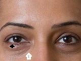 Under Eye Dark Circles: Causes, Treatment, Remedies