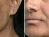 Melasma, Hyperpigmentation, Freckles, Dark Spots Best Treatment