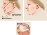 Face Wrinkles Treatment -Face Lift / Rhytidectomy