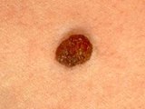 Moles Skin Lesions & their Removal