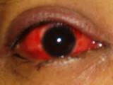 Red Eyes – Causes & Treatment
