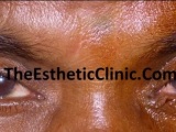 Eyelid Tumours & Eyelid Mass – Is It Eyelid Cancer?